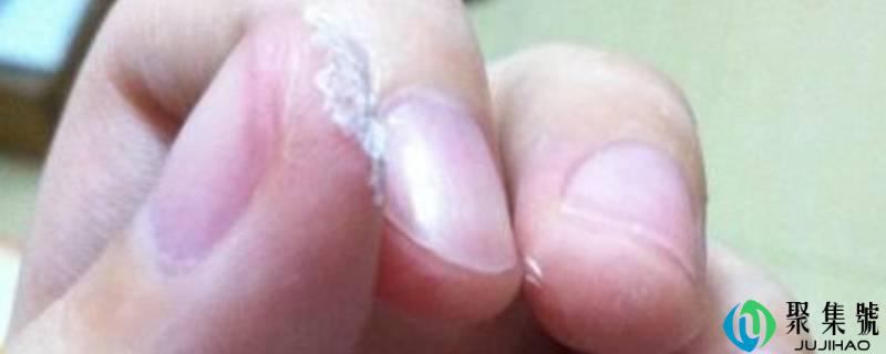 焊接剂胶水粘到手怎么办