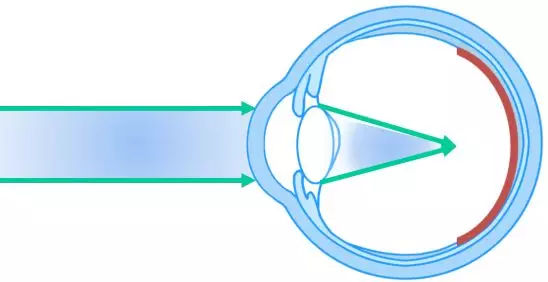 两眼视力悬殊怎么矫正(两眼视力悬殊怎么矫正 眼罩)
