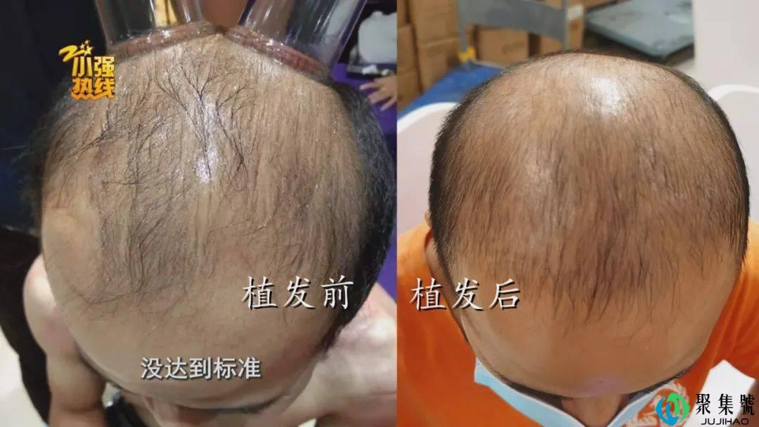 男子去植发,15元1根,付款时惊呆了:根本还不起……