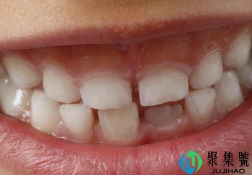 洗牙会使牙缝变大吗(洗完牙牙缝会变大吗)