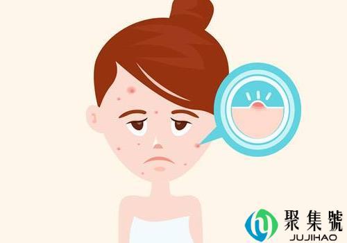 痤疮会自愈吗   有几种类型