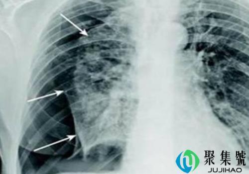 轻微气胸一般几天自愈 为什么瘦的人容易气胸