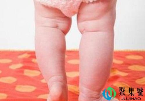 罗圈腿常见的几种症状   如何预防