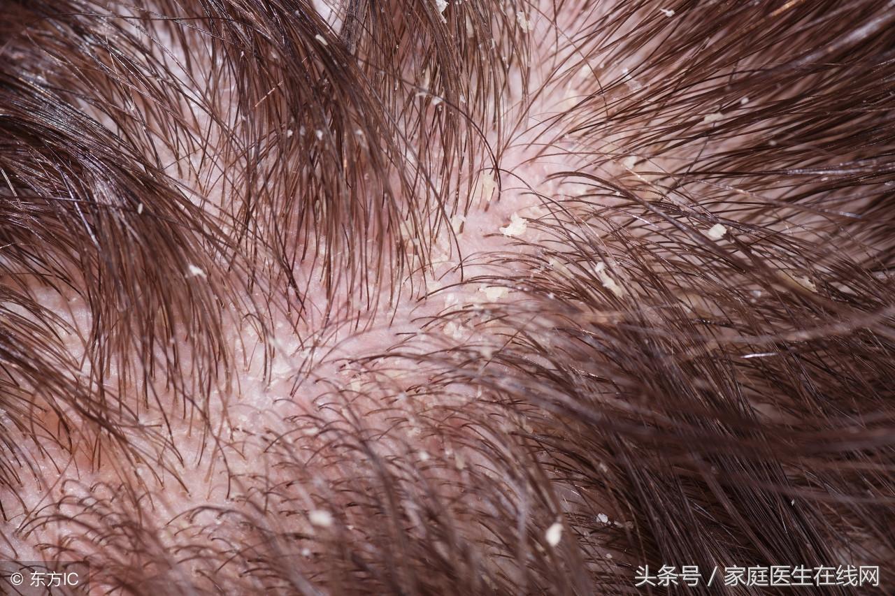 头皮屑多怎么办啊头皮屑根除(头皮屑多怎么办小妙招)