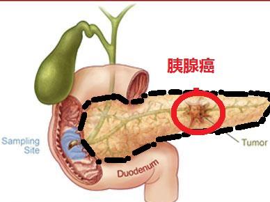 胰腺在人体的哪个部位图解(胰腺是哪个部位疼 位置图)
