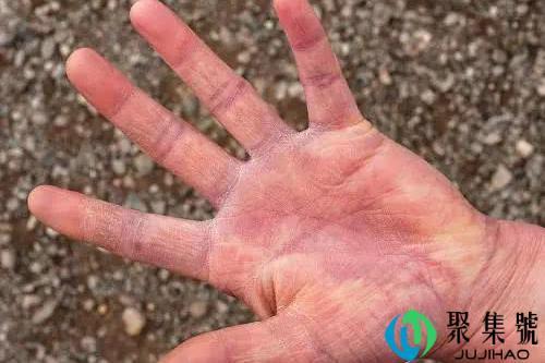 皲裂和龟裂的区别