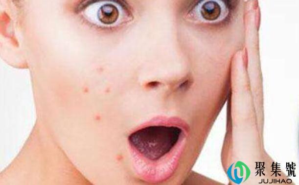 去痘痘的小窍门