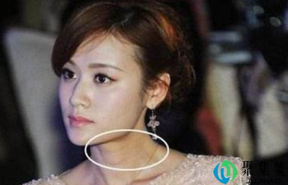 凡士林能不能去颈纹