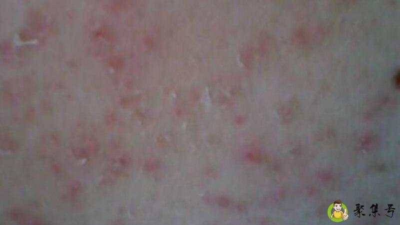 皮肤晒红以后为什么会痒怎么办