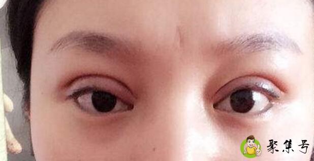 割双眼恢复过程