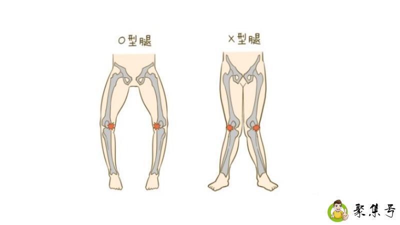 o型腿走s路线是什么意思