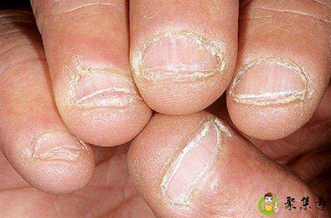 喜欢咬指甲的人的性格