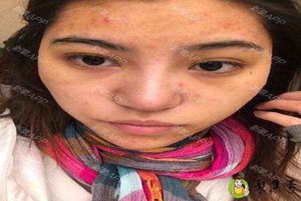 详细阅读:角栓和油脂粒区别 角栓和油脂粒区别